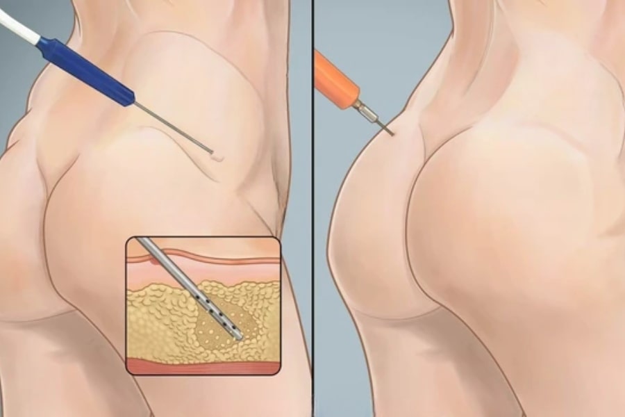 Thế nào là cấy mỡ mông tự thân?