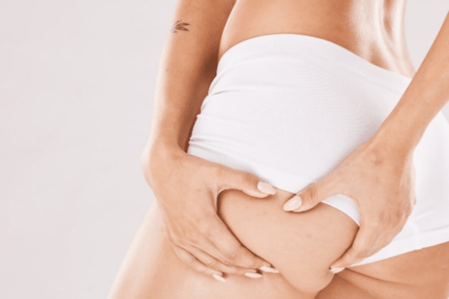 Có nên cấy mỡ tự thân để cải thiện hõm hông không? 