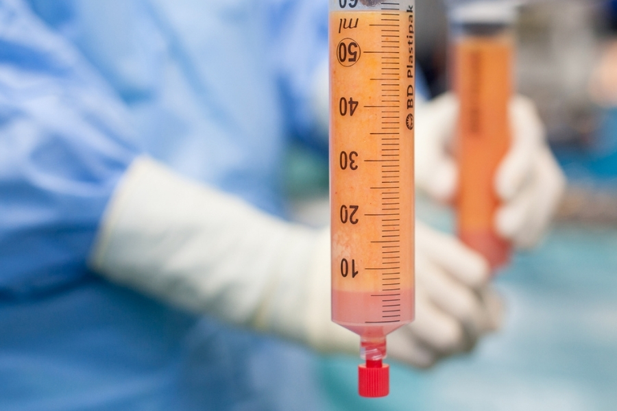 Cấy mỡ tự thân lấy mỡ từ cơ thể của người thực hiện