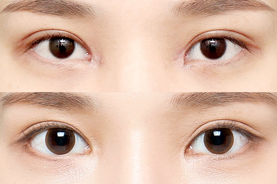 Nếu mắt có nhiều khuyết điểm, bạn có thể cân nhắc, xem xét phẫu thuật thẩm mỹ mở góc mắt để có được một cuộc sống chất lượng hơn