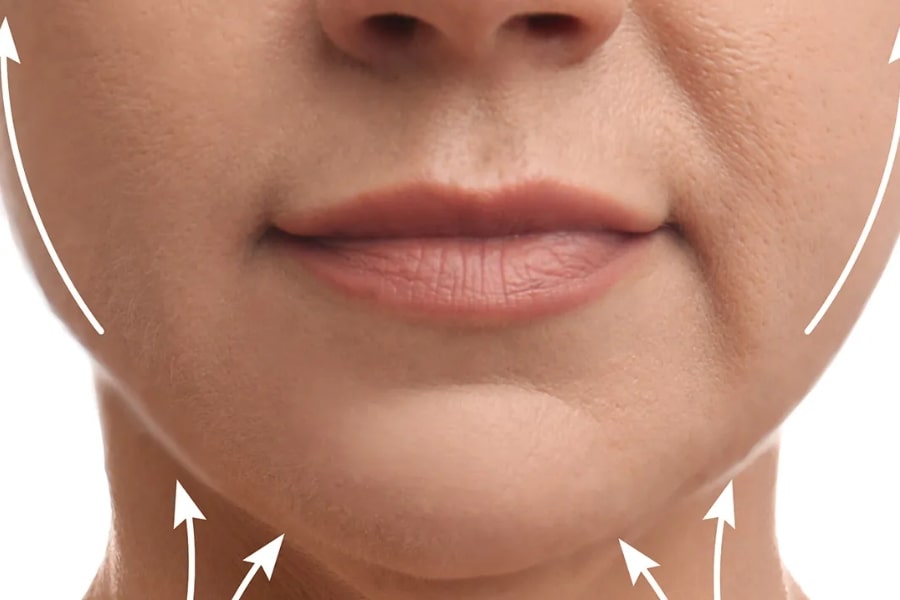 Những ai nên lấy mỡ má?