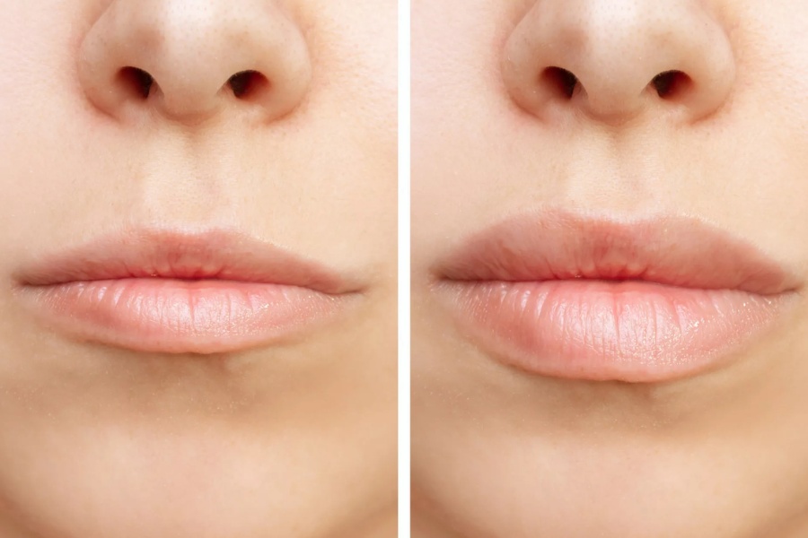 Bơm filler môi giúp môi căng mọng, mịn màng hơn