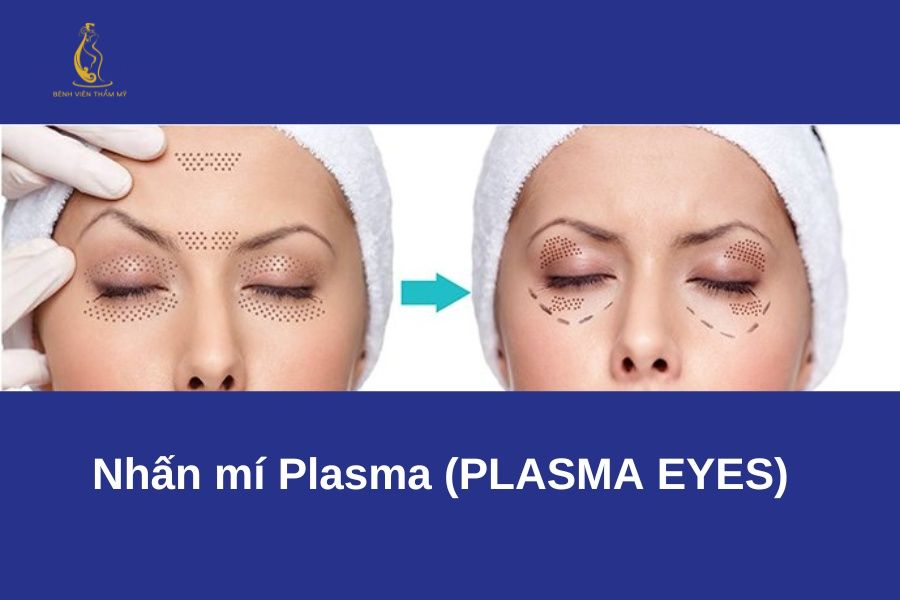 Nhấn mí mắt: Thông tin cần biết từ A–Z trước khi nhấn mí 14 Công nghệ Plasma hiện đại vừa định hình nếp mí đều đẹp vừa thúc đẩy tế bào tái tạo nhanh, trẻ hóa vùng da mắt