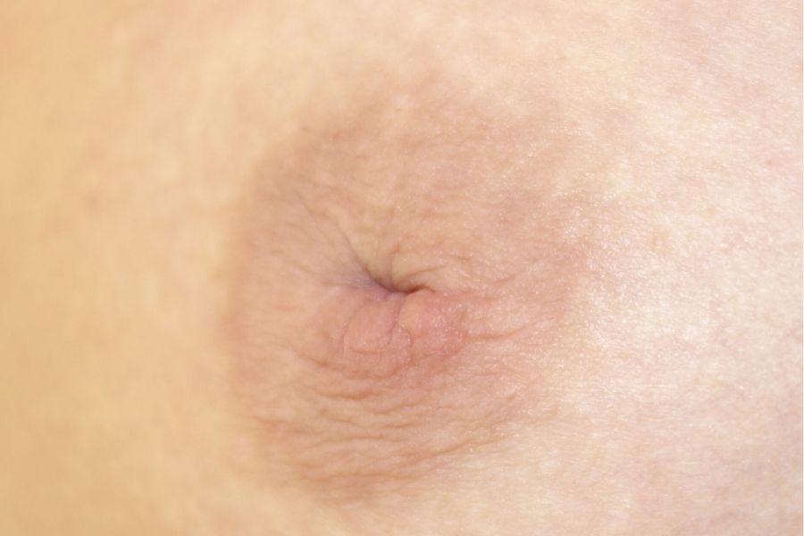 Núm vú tụt cấp độ 3 là núm vú sẽ bị lõm hẳn vào trong