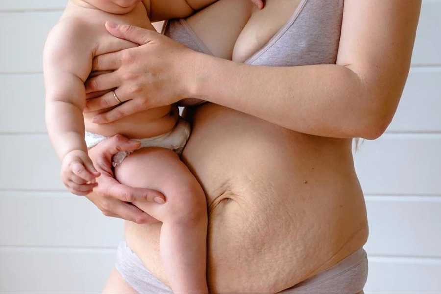 Phụ nữ sau sinh nhiều mỡ bụng có thể thực hiện hút mỡ siết eo