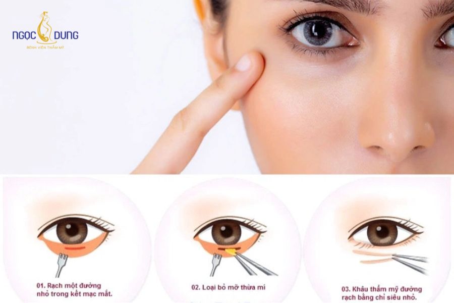Cắt mí mắt dưới là gì? Có nên phẫu thuật cắt mí dưới không? 9 Đường rạch siêu vi phẫu ẩn sát chân râm mi giúp quá trình cắt mí dưới đạt độ giấu sẹo tuyệt đối, đẹp tự nhiên không tì vết