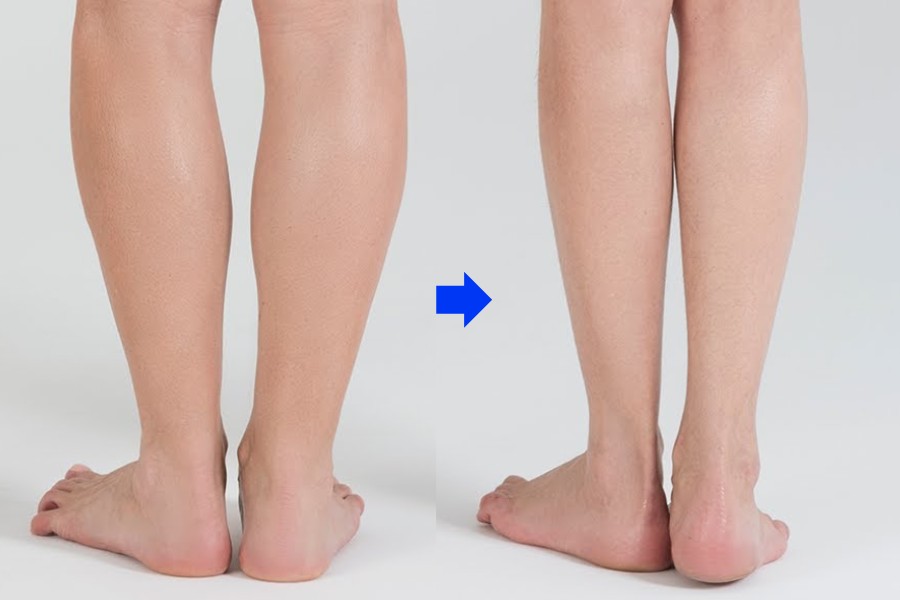 giảm mỡ bắp chân
