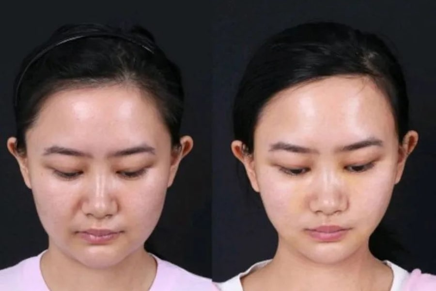 Cách chăm sóc sau khi lấy mỡ má