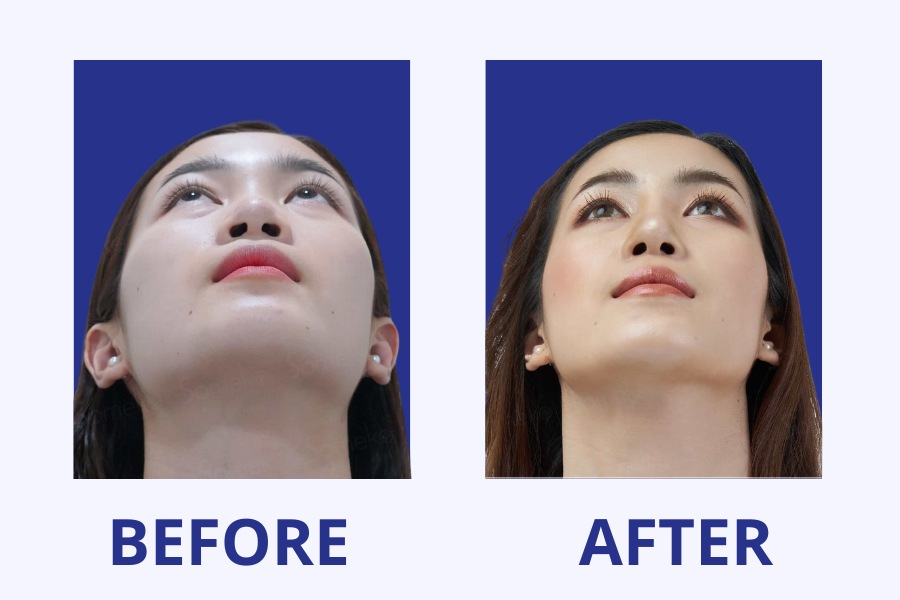 Chỉnh sửa mũi hỏng - Kiến tạo dáng mũi tự nhiên