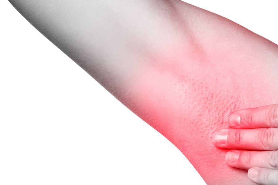 biến chứng hút mỡ nách