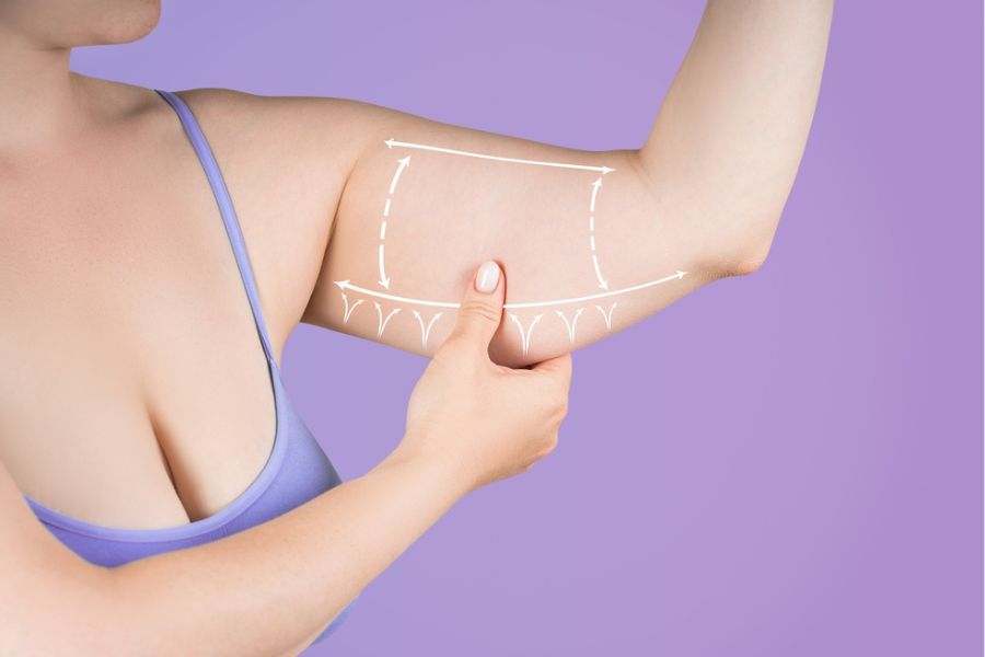 hút mỡ bắp tay là gì