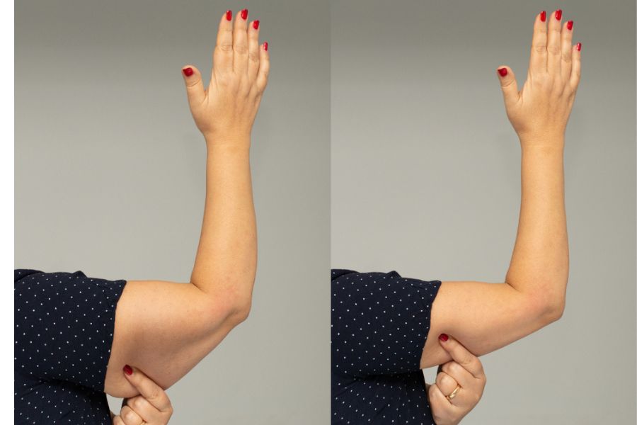 Bắp tay sẽ  hết sưng hoàn toàn sau khoảng 1-2 tháng sau hút mỡ