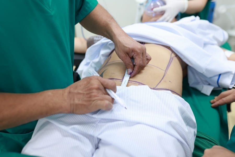 Hút mỡ bụng siết eo giúp vóc dáng thon gọn tại Bệnh viện Thẩm mỹ Ngọc Dung