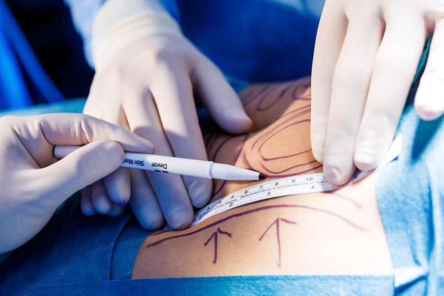 Đo vẽ thực hiện hút mỡ đùi