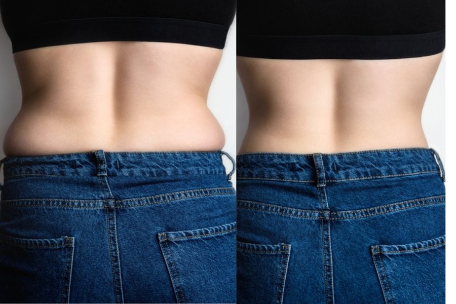 hình ảnh trước và sau khi hút mỡ lưng hông