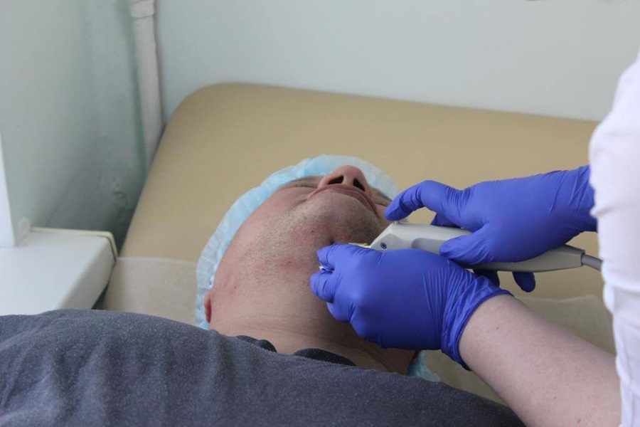 Vùng cằm có thể bị sưng đỏ sau khi hút mỡ nọng