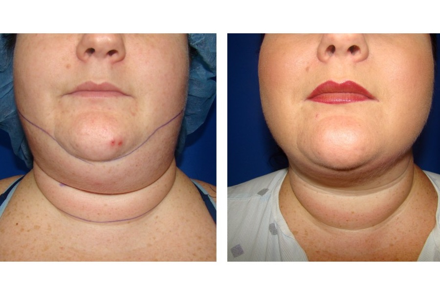 Giá hút mỡ nọng cằm trên thị trường dao động trong khoảng từ 15.000.000 - 30.000.000 VNĐ