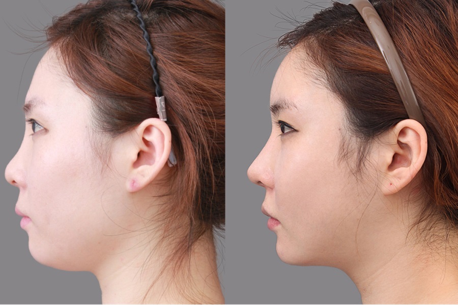 Kết quả trước và sau khi thực hiện hút mỡ nọng cằm