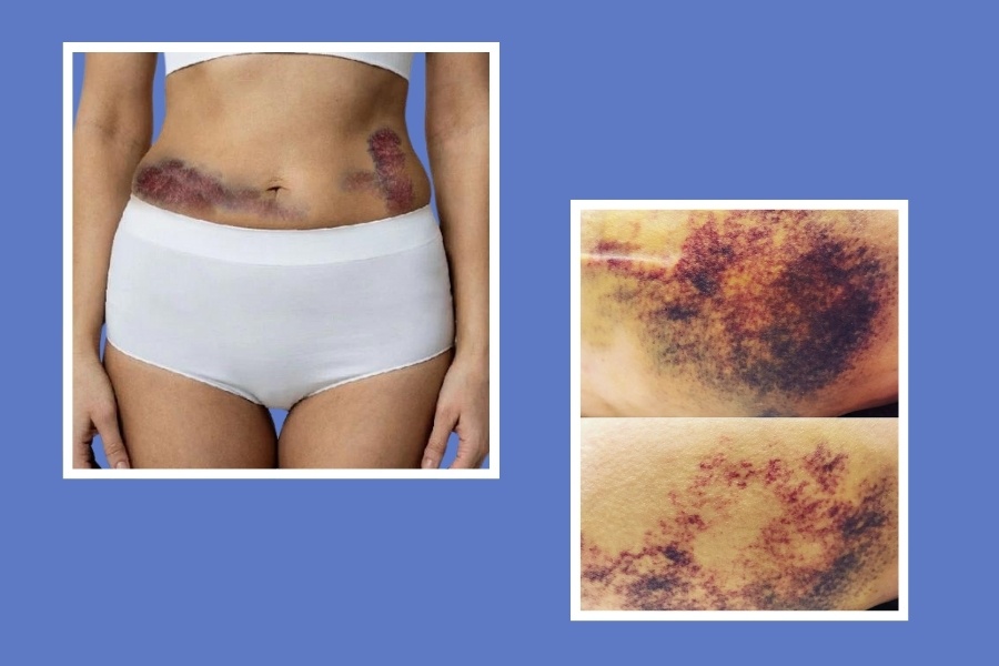 biến chứng sau khi hút mỡ bụng siết eo