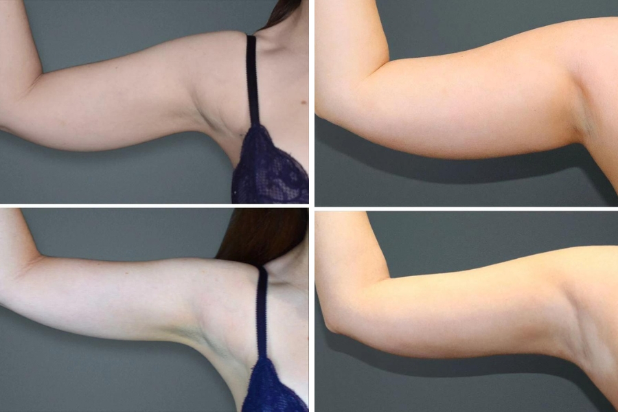 Một số kết quả sau khi cắt da nách: Vùng da nách thon hơn, trông quyến rũ, cân đối hơn