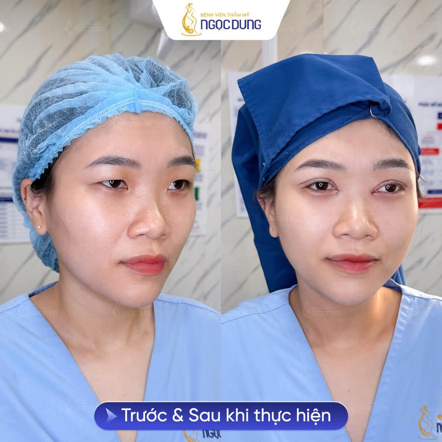 Mở góc mắt là gì? Ưu nhược điểm của cắt mí mở hốc mắt 14 Kết quả thực hiện cắt mí kết hợp mở góc mắt của khách hàng tại Bệnh viện Thẩm mỹ Ngọc Dung