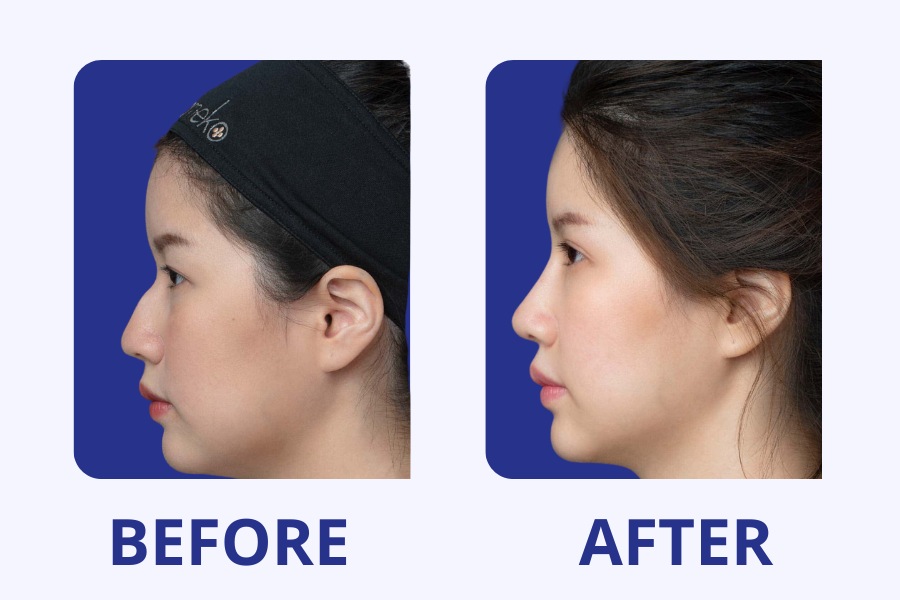 Chị Đẹp tự tin khoe chiếc mũi siêu xinh sau khi chỉnh sửa mũi tại BVTM Ngọc Dung