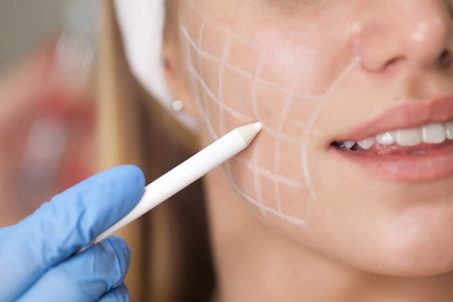 Có nên lấy túi mỡ má không?