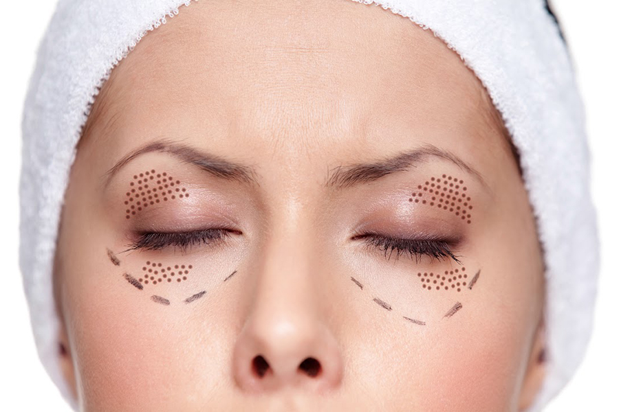 Lấy mỡ mí mắt trên