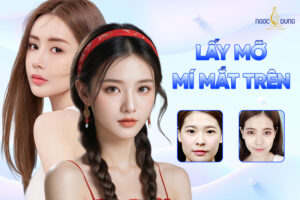 lấy mỡ mí mắt