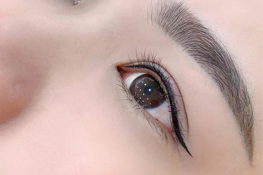 Lấy mỡ mí mắt bao lâu thì lành