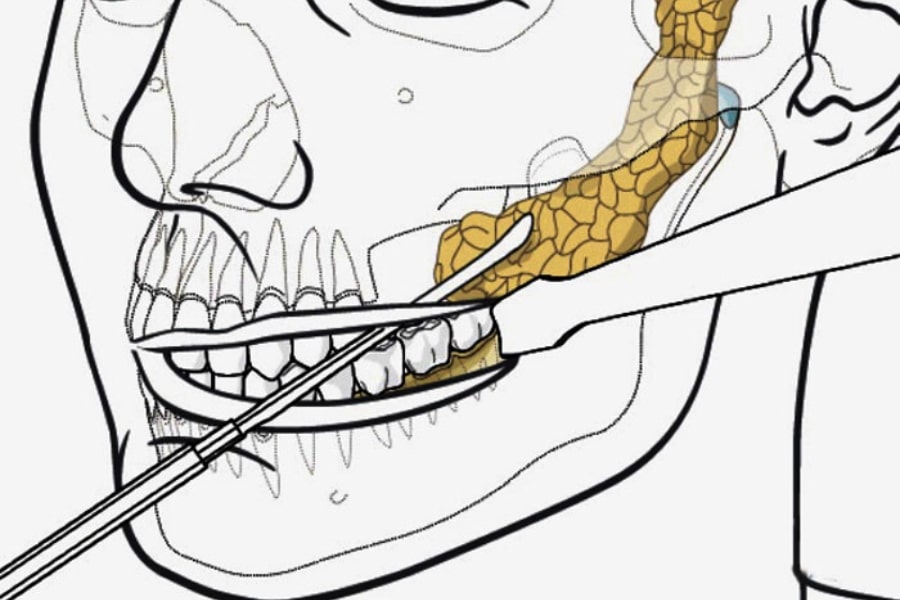 Mô phỏng thực hiện lấy túi mỡ má