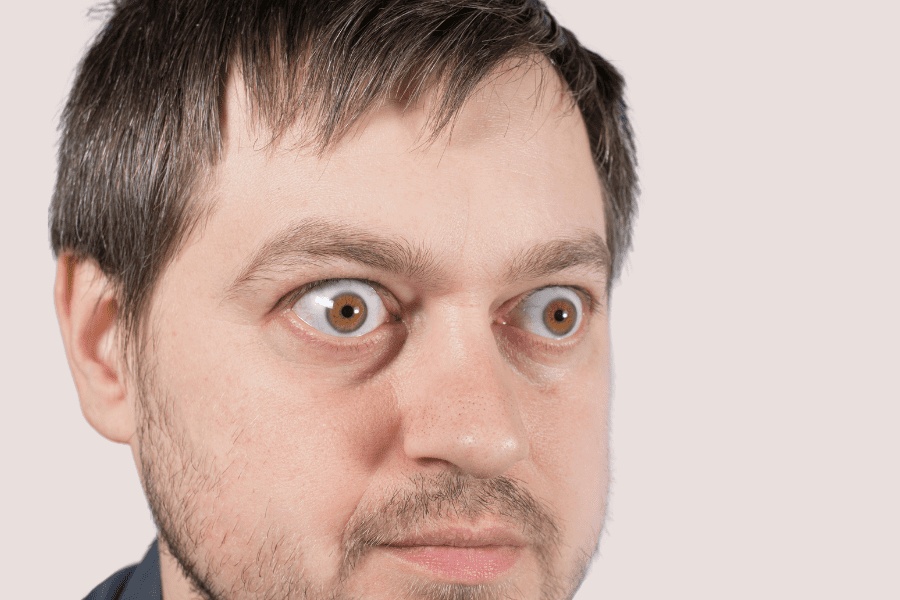 Mắt lồi có thể cắt mí hay bấm mí được không phụ thuộc vào nguyên nhân gây lồi mắt và tình trạng mắt bị lồi nặng hay nhẹ