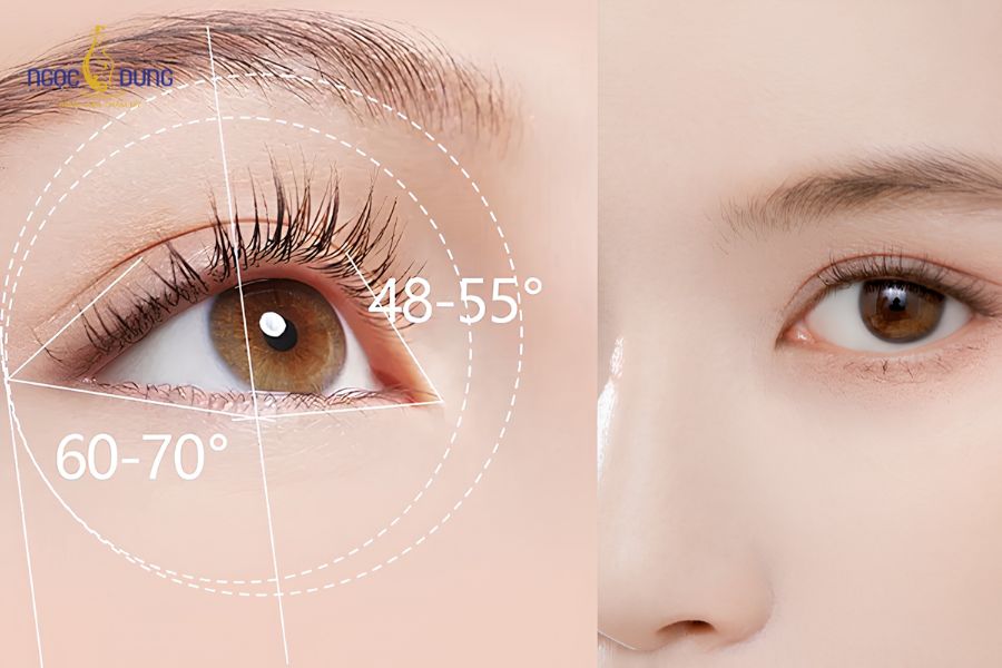 Mở góc mắt là gì? Ưu nhược điểm của cắt mí mở hốc mắt 10 Minh họa vị trí kết hợp giữa kỹ thuật tạo nếp mí đôi và mở rộng góc mắt giúp mắt to tròn hơn