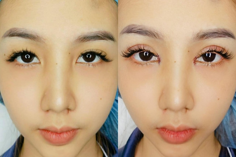 Xác suất để lại sẹo sau khi mở rộng góc mắt thường rất thấp