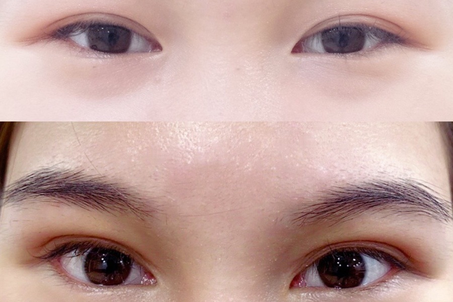 Mở rộng góc mí chỉ là một tiểu phẫu nhỏ nên không gây nguy hiểm