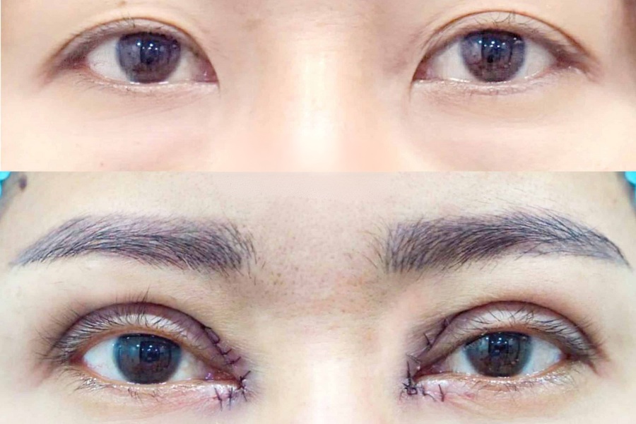 Mở góc mắt trong giúp loại bỏ da chùng, mỡ thừa ở phần khóe mắt trong, đồng thời điều chỉnh nếp rẻ quạt để mở rộng góc mắt