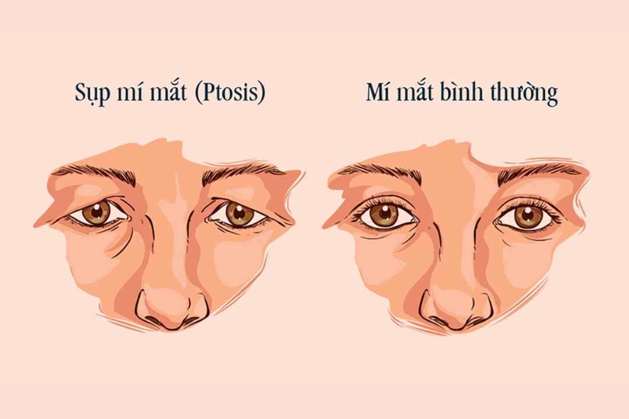 Mỡ mí mắt gây sụp mí
