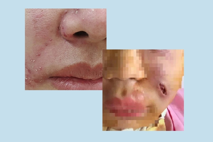 Xuất hiện vết sưng, ổ mủ viêm sau khi cấy mỡ rãnh mũi má