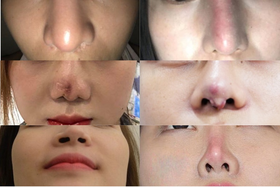 Mũi hỏng do thẩm mỹ nâng mũi hoàn toàn có thể sửa lại được