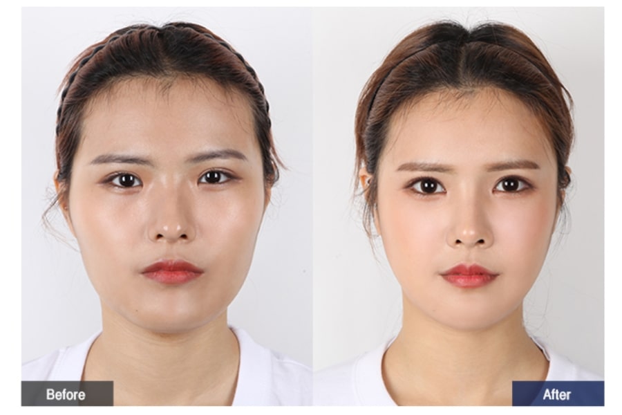 Phẫu thuật nâng gò má có nguy hiểm không?