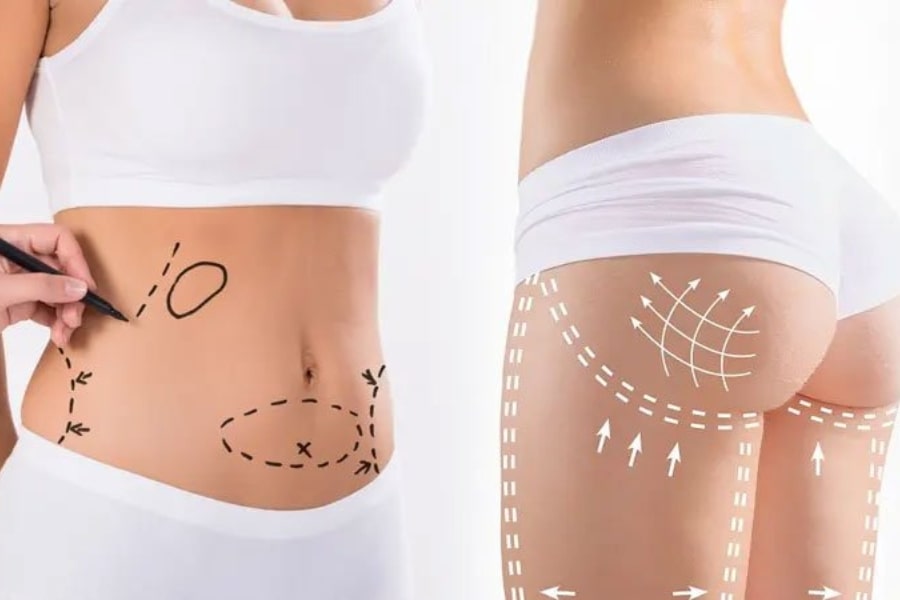 Các yếu tố ảnh hưởng đến thời gian duy trì kết quả của cấy mỡ mông