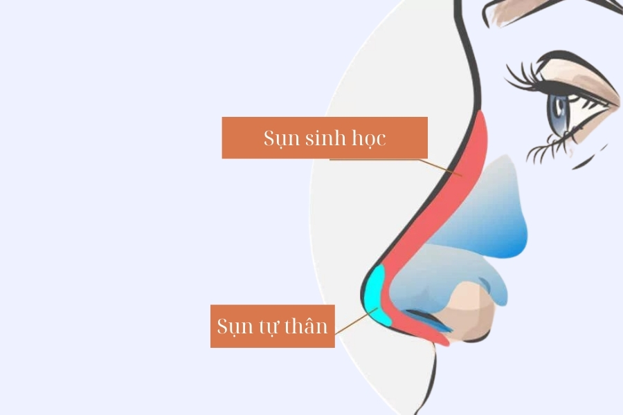 Nâng mũi S line cấu trúc sử dụng sụn sinh học và sụn tự thân