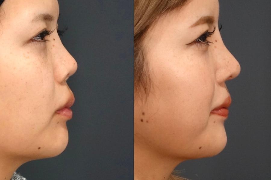 Nâng mũi S line là gì? Tại sao lại được chị em ưa chuộng 13 nâng mũi s line là sao