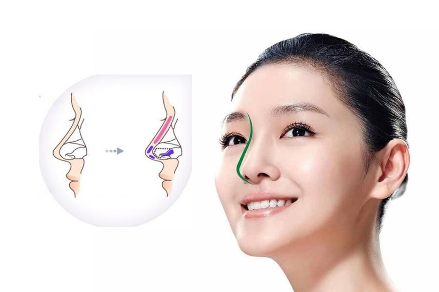 Nâng mũi S line là gì? Tại sao lại được chị em ưa chuộng 12 nâng mũi s line tự nhiên