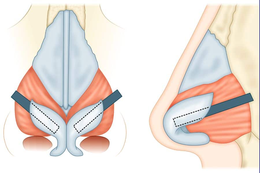 nâng mũi sụn tự thân