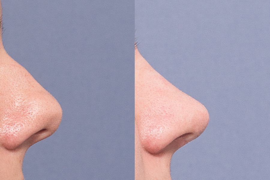 Nâng mũi tự thân Ngọc Dung: Thay dáng mũi, đổi vận mệnh 8 nâng mũi sụn tự thân hoàn toàn