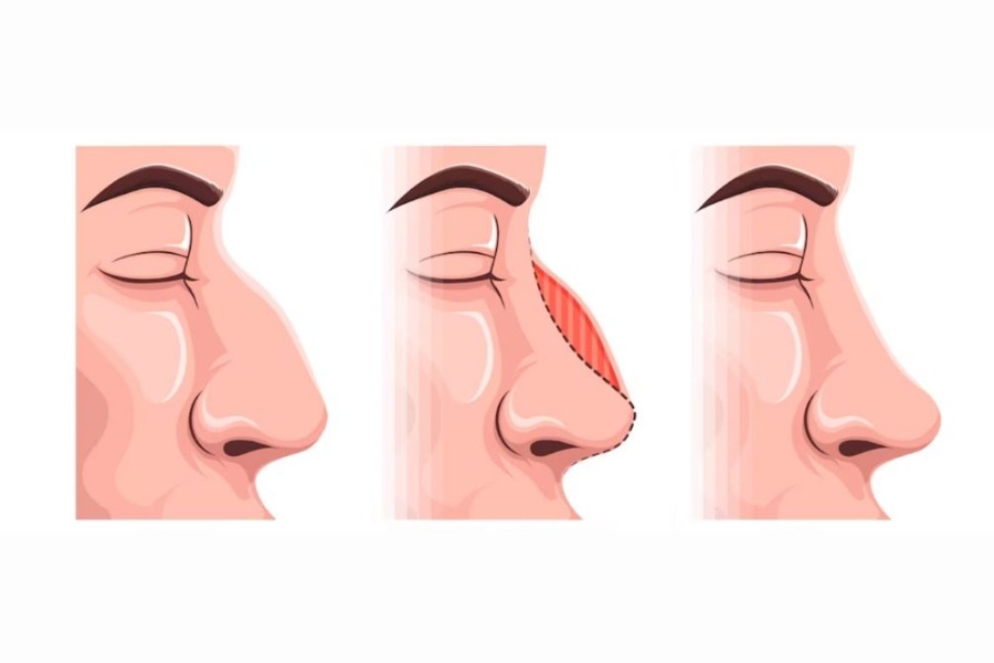 Nâng mũi tự thân là gì? Nâng mũi bằng sụn tự thân tốt không?