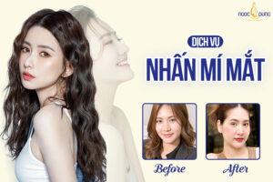 Nhấn mí - Bí quyết sở hữu đôi mắt đẹp như ý không cần phẫu thuật