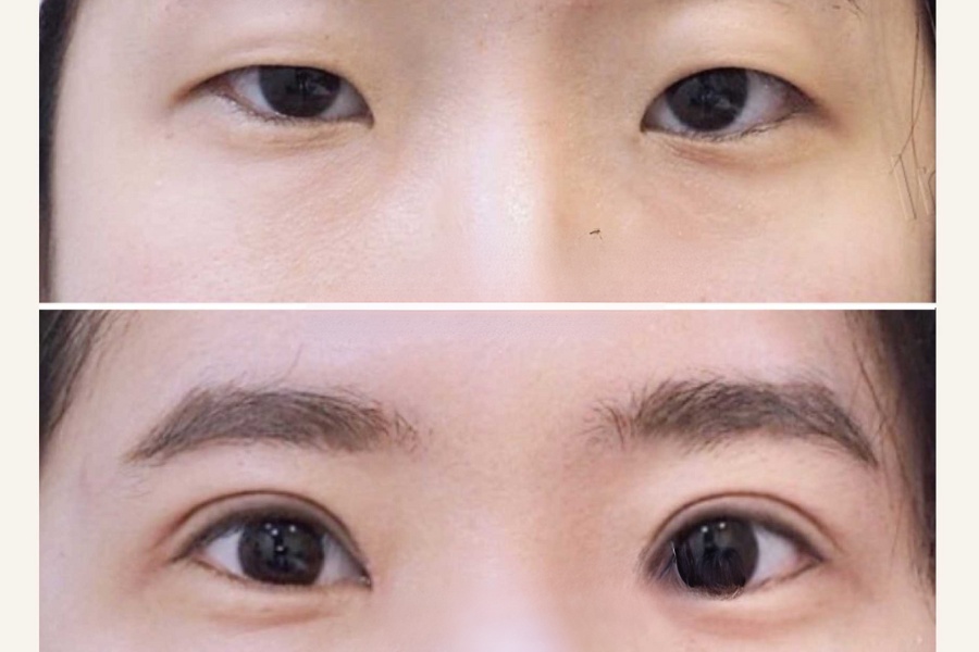 Nhấn mí là như thế nào? Đây là phương pháp làm đẹp tạo hình mắt 2 mí không phẫu thuật