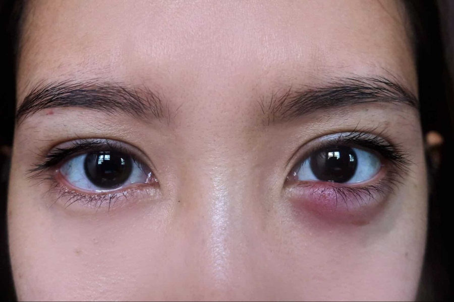 Dù không phẫu thuật, ít xâm lấn nhưng nếu được thực hiện tại các cơ sở thẩm mỹ không uy tín thì vẫn có khả năng để lại biến chứng nguy hiểm